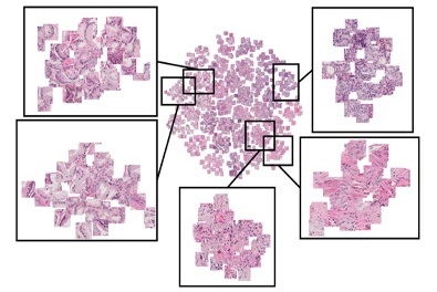 Imagen: Un mapa de grupos de diferentes patrones de cáncer de próstata detectados por la herramienta de IA PATHOMIQ PRAD a partir de imágenes de tejido teñido (Foto cortesía de Nair, et al. (2024), European Urology)